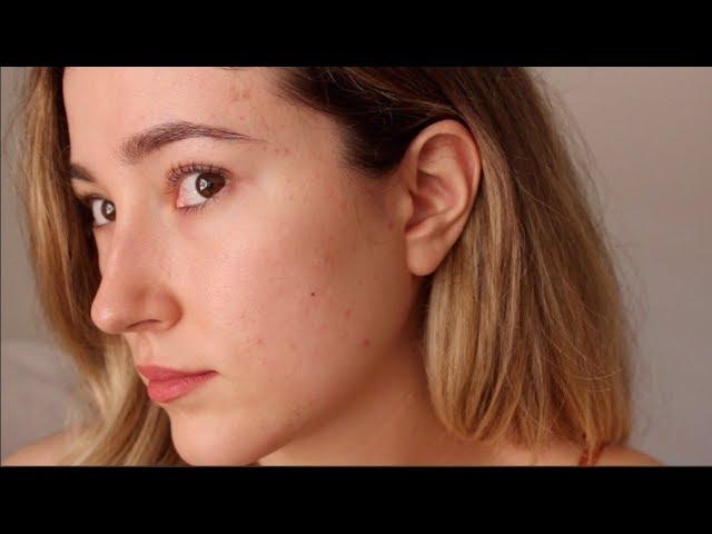 One Year Off Accutane: My Acne Is Back. An Emotional Update