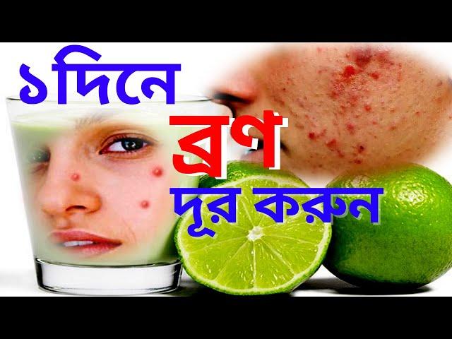 আপনার মুখে কি ব্রণ ? মাত্র একদিনেই মুখের কালোদাগ ও ব্রণ দূর করুন | Health Success Bd