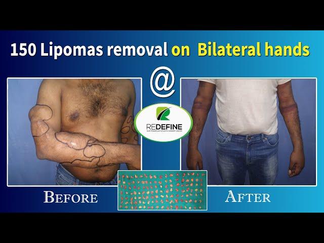 Multiple Lipomas Removal @ Redefine Plastic Surgery Centre || Dr Hari Kiran Chekuri || 92371 23456