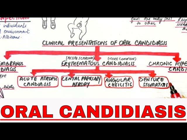 Oral Candidiasis - Causes, Clinical presentations, Treatment