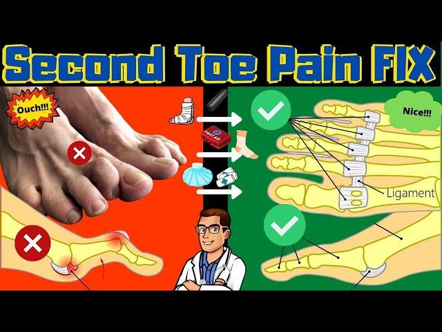 Second Toe Pain TREATMENT [Capsulitis, Taping & Freiberg Disease FIX]