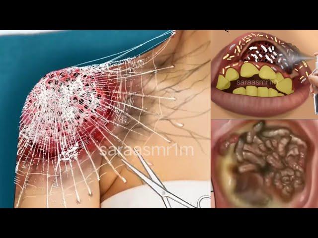 ASMR Remove Big Acne & Worm Infected Back | Deep Cleaning Animation