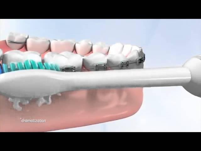 Tips on how use a Philips Sonicare toothbrush with braces. Hygiene is a key part of daily care.