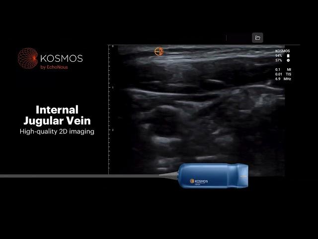 Kosmos by EchoNous for Vascular Access Ultrasound Capabilities