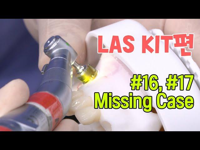 [LAS KIT] #16, #17 Missing Case