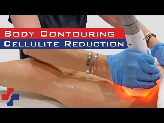 Body Contouring and Cellulite Reduction with the Most Popular Radio-Frequency Device