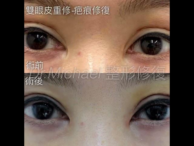 【案例分享】雙眼皮眼頭凹疤～沈筠惇