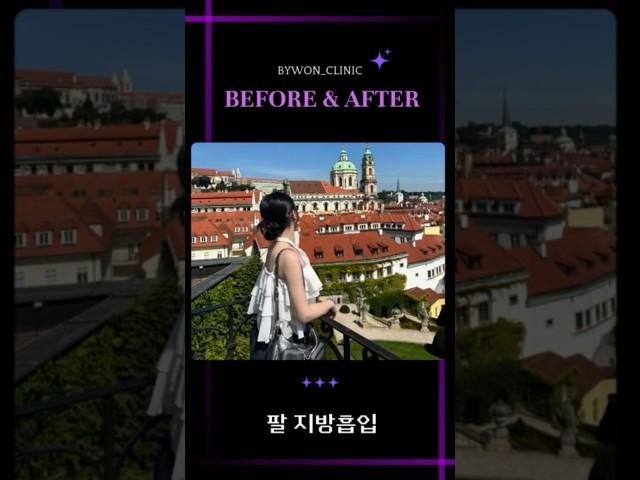 팔 지방흡입 #팔지방흡입