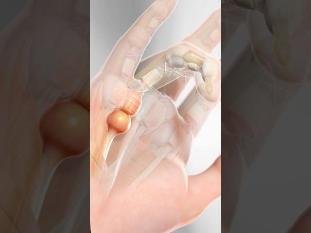 Trigger Finger (3D Animation)