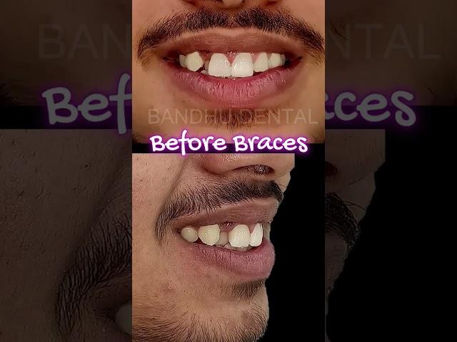 Want a Great Smile?#bracesbeforeandafter #fullmouthdentalimplants #dentalimplants