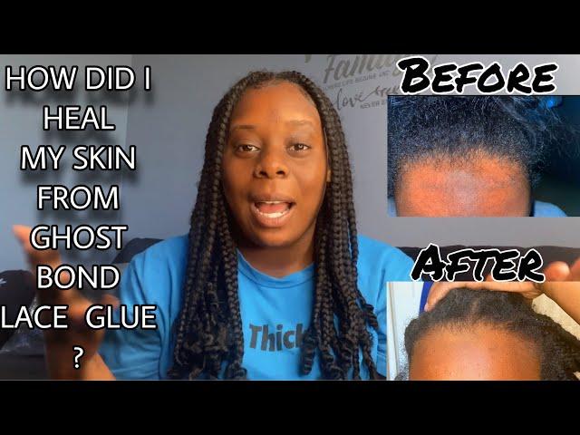 *MUST WATCH* How Did I Heal My Skin From Ghost Bond Lace Glue?