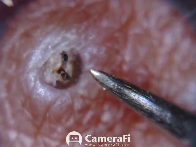 Itchy ingrown hair removed