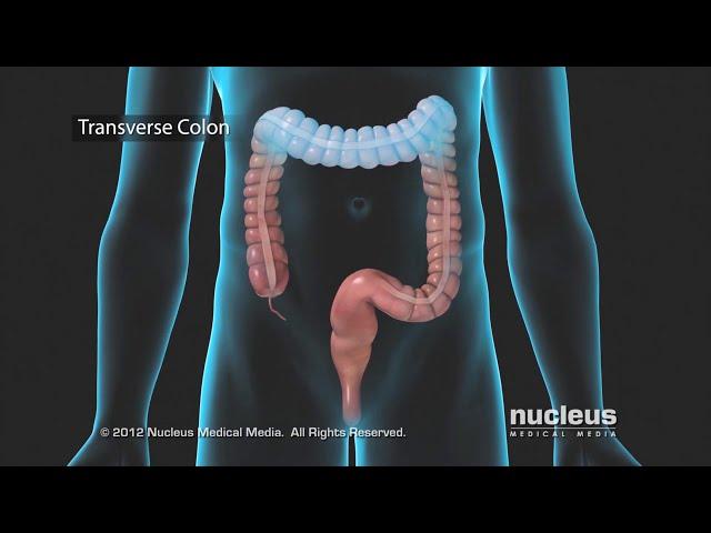 Colon Problems: Diverticular Disease