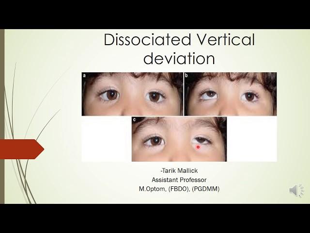 DISSOCIATED VERTICAL DEVIATION