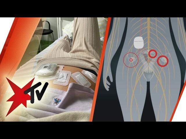 Endometriose: Kann ein neuer "Schmerzschrittmacher" endlich helfen? | stern TV