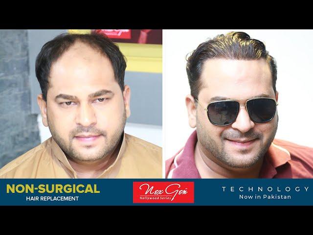 Non Surgical Hair Replacement at Hair Club Pakistan. Complete Process with Amazing Transformation