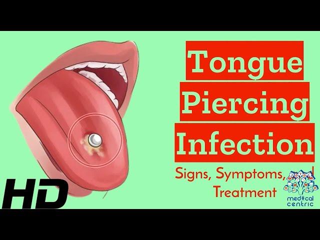 Tongue Piercing Gone Wrong? Recognize Infection Signs and Solutions