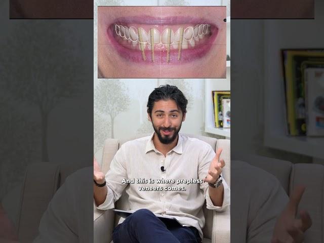 Prepless Veneers: A Case Discussion I Dr. Khalid Aldabbas