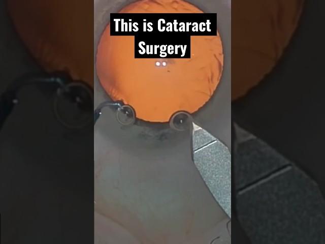 Entire CATARACT surgery in less than a minute