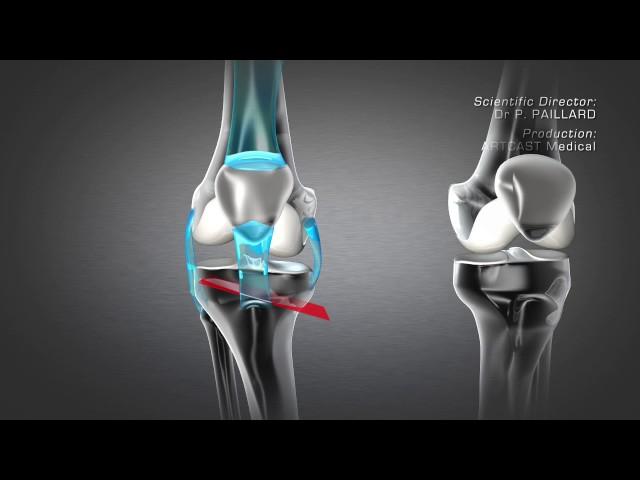 Tibial Valgus Osteotomy