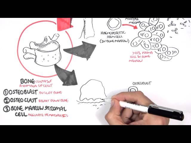 Multiple Myeloma - signs and symptoms, pathophysiology, treatment