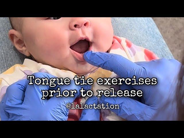 Infant tongue exercises prior to tongue and lip tie release