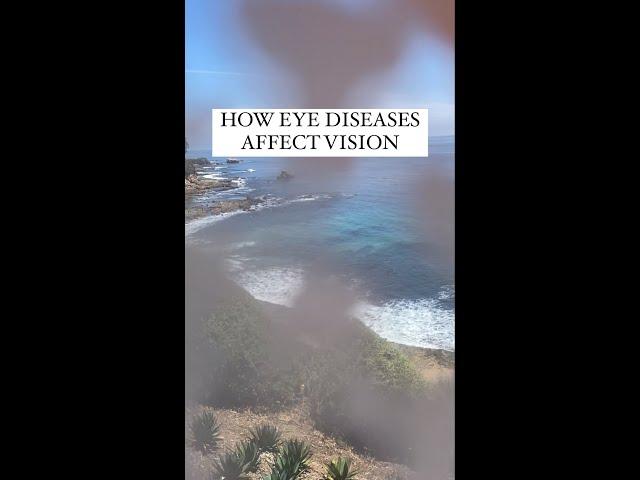 How Eye Disease Affect Vision #shorts #vision