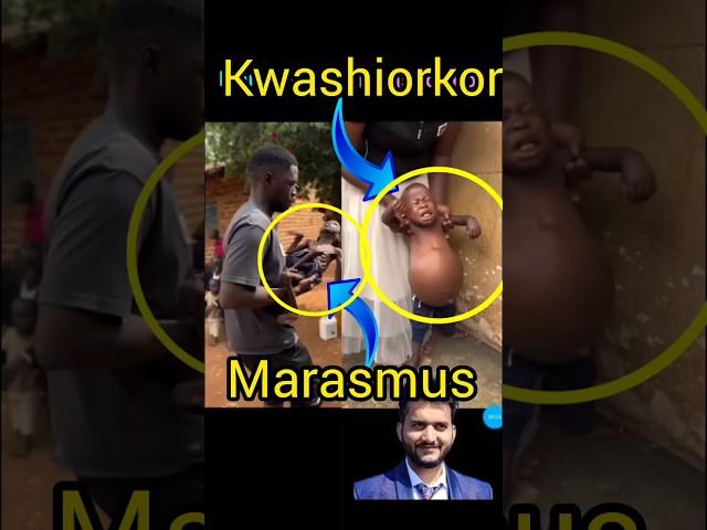 Kwashiorkor and marasmus #shorts @pna1