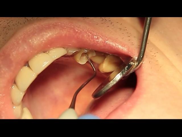 Tooth extraction, endodontic treatment, II stage of implantation. Professor Orlov