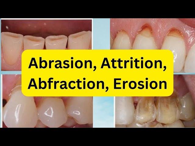 Abrasion, Attrition, Erosion, Abfraction (SIMPLIFIED)