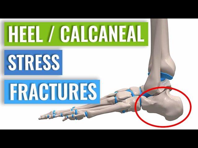 Heel/Calcaneal Stress Fracture: Causes, Symptoms & Treatment