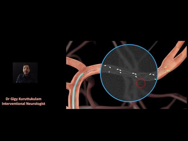 Stentrivers for Stroke Treatment - The Stroke Academy