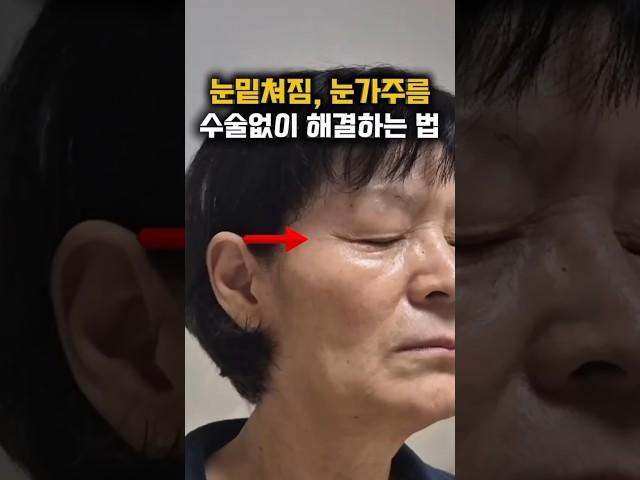 굵은 눈가주름, 눈밑꺼짐 집에서 해결하는 방법! 아이팔트 아이백크림으로 움푹패인 주름을 채워주세오. 🩵구매링크는 게시글 참고해주세요🩵 #주름 #주름없애는법 #눈가주름 #눈밑주름