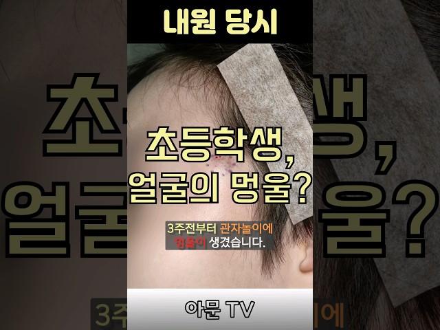초등학생 얼굴 관자놀이 근처 멍울 핀홀법 수술 치료 후기 [아문TV]