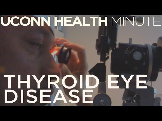 UConn Health Minute: Thyroid Eye Disease