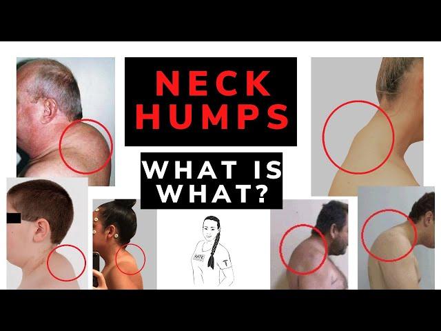 Neck hump - dowager's hump or buffalo hump? What is what?!