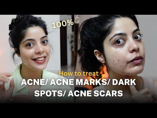 How I get rid of Acne, Acne Spots & Dark Spots ? Products that ACTUALLY WORKS