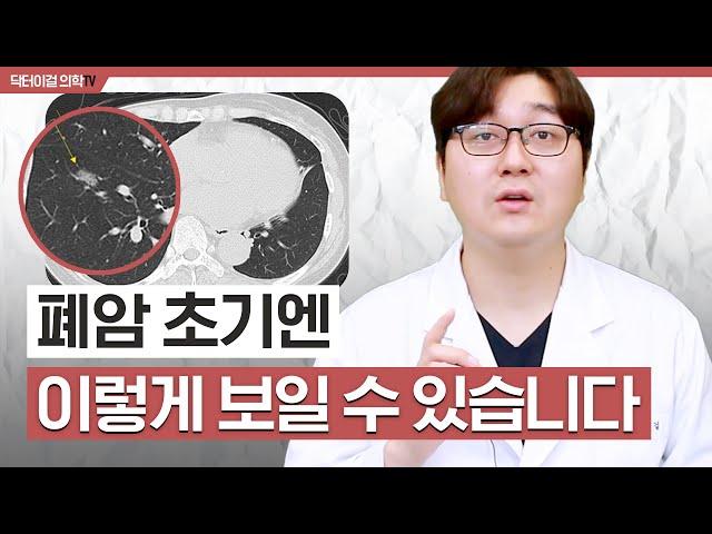 느리지만 확실히 폐암이 될수 있는 질병