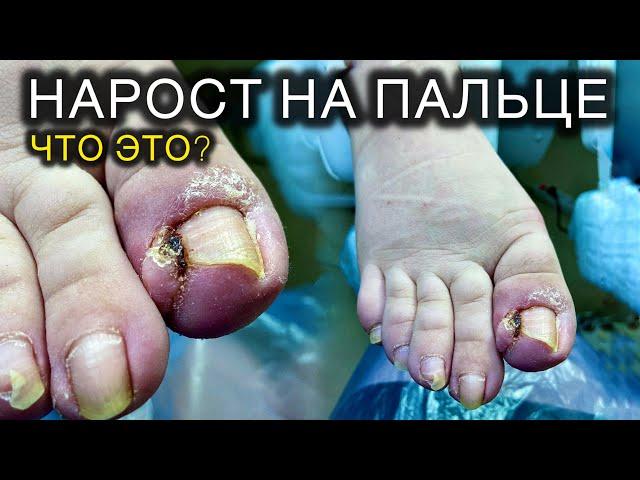 ВЫРОСЛА ГРАНУЛЁМА | НОГОТЬ ПОСЛЕ УДАЛЕНИЯ У ХИРУРГА #подолог #подология #обучениеподологии