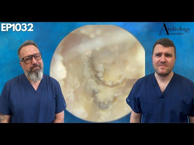 Removing a FUNGAL INFECTION from someone's EAR CANAL - EP1032