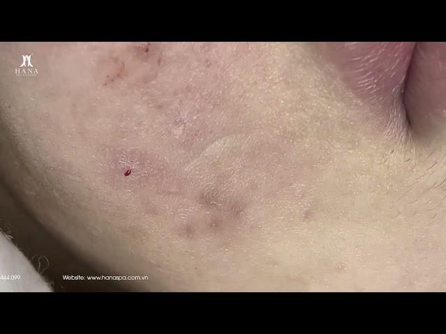 Big Cystic Acne Blackheads Extraction Blackheads & Milia, Whiteheads Removal Pimple Popping