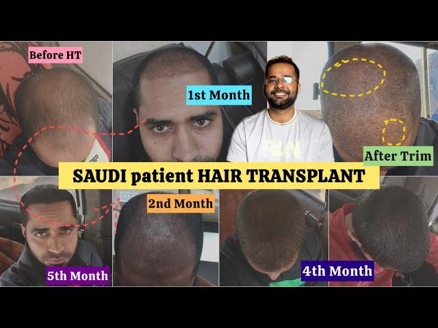 My 5 Month Hair Transplant Result | Saudi to Delhi, india for Hair Transplant