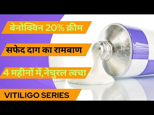 Benoquine Cream-सफेद दाग का सस्ता इलाज||मात्र 4 महीने में सफेद दाग की छुट्टी|| #Vitiligo #सफेद_दाग