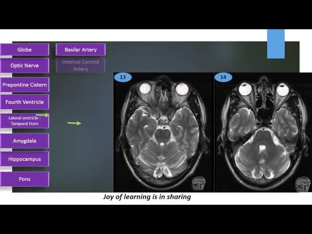 MRI Brain Sectional Anatomy Cut 13 & 14