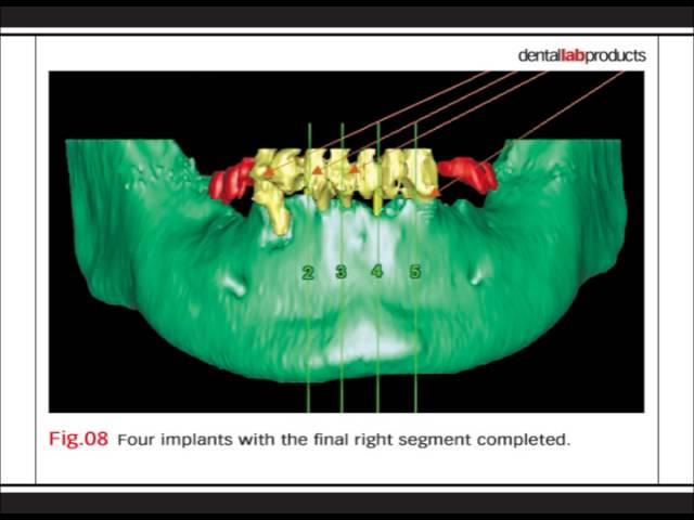 Bench mastery: Complete implant maxillary and mandibular reconstruction