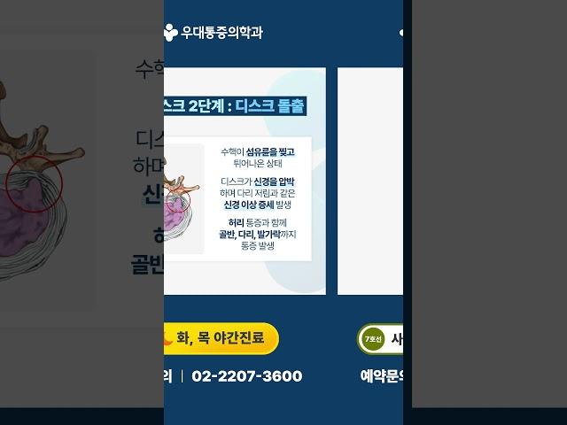 사가정정형외과 단계별 허리디스크 증상!