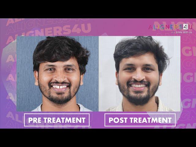 Your Smile, Transformed | Clear Aligners | Invisible Braces | Aligners4U | Hyderabad | India | Teeth