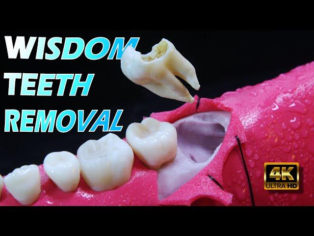 Wisdom Teeth Removal in 4K | Wisdom Teeth Aftercare