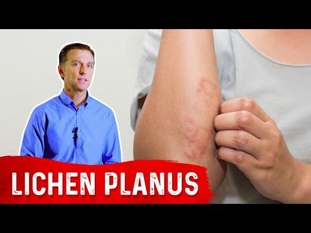 Lichen Planus: Best Remedy