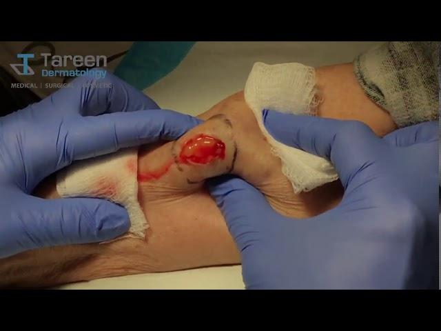 Lipoma Removal